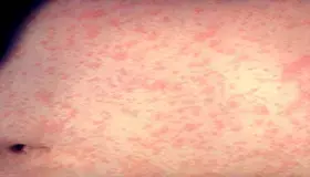 عکس سرخک روی بدن