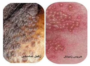 تفاوت زگیل تناسلی با تبخال تناسلی با عکس