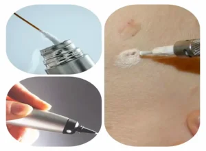 عکس زگیل تناسلی