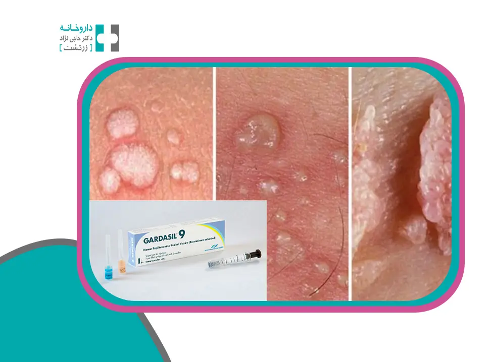 زگیل تناسلی و واکسن گارداسیل