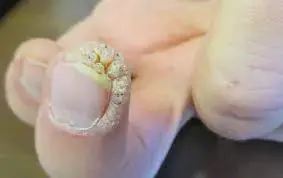 زگیل ناخن عکس